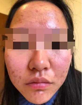 问题肌36计:4大级别痘痘如何对抗你知道吗?调理代谢很重要