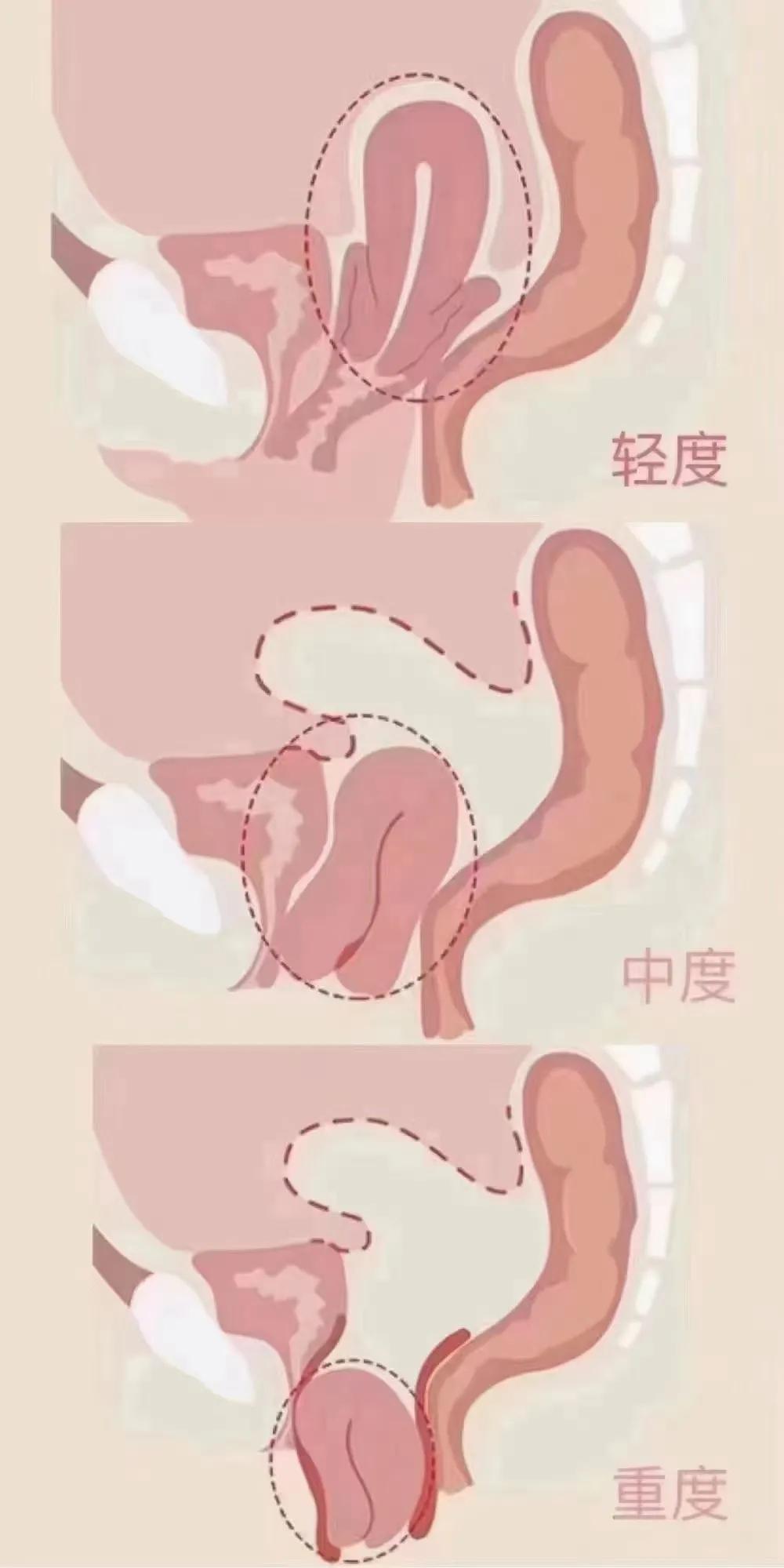 产后修复老公的方法,已婚女人必备产后修复