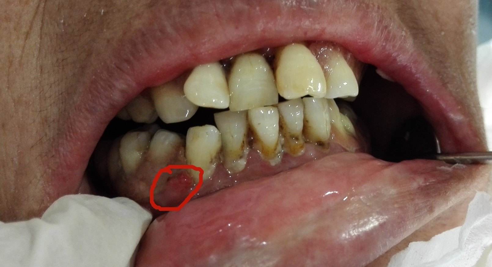 牙龈红肿发炎疼痛吃什么药,孩子牙龈红肿疼痛怎么办