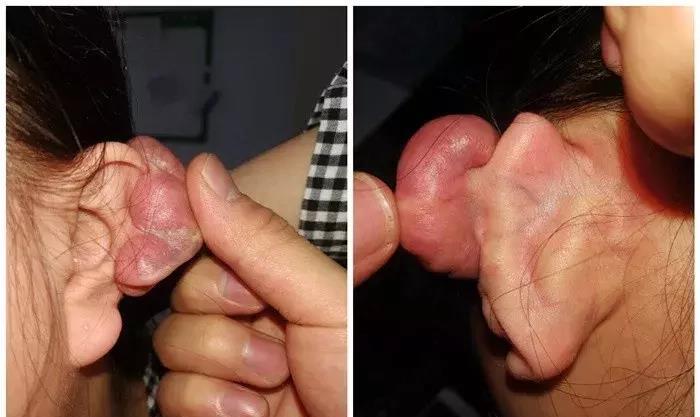 美女打耳洞后在株洲长出了“新耳朵”！