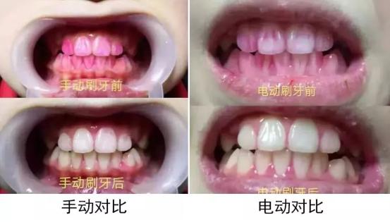 电动牙刷的利与弊总结,电动牙刷刷牙的弊端