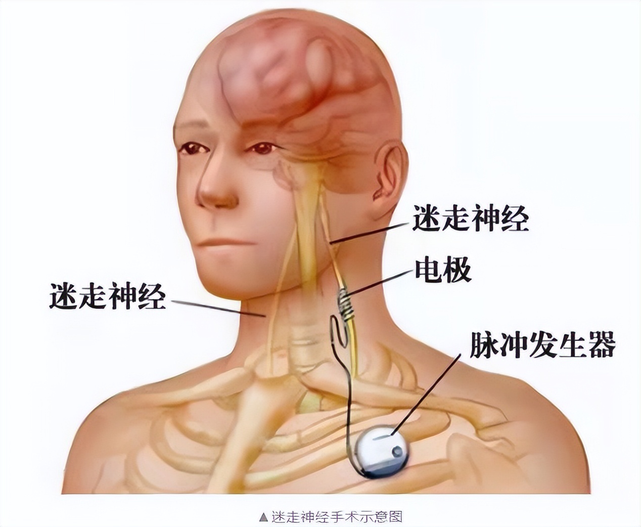 齐鲁医院：迷走神经刺激术（VNS）治疗药物难治性癫痫效果怎样？