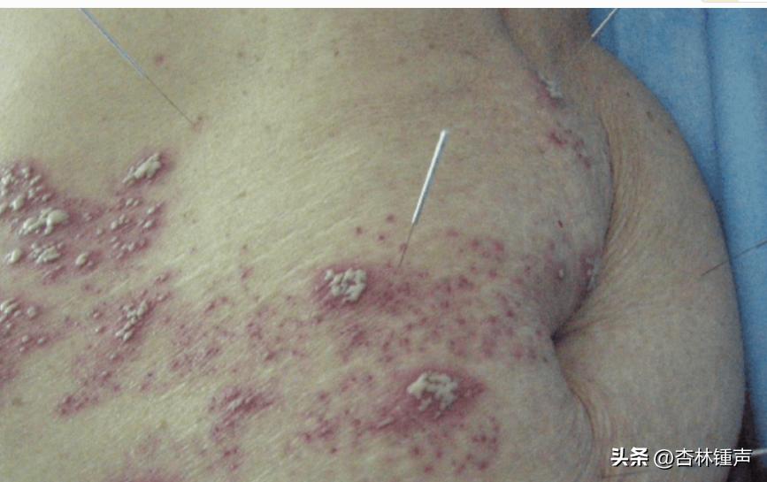 带状疱疹是什么样的怎么治,带状疱疹长在眼睛附近要特别注意