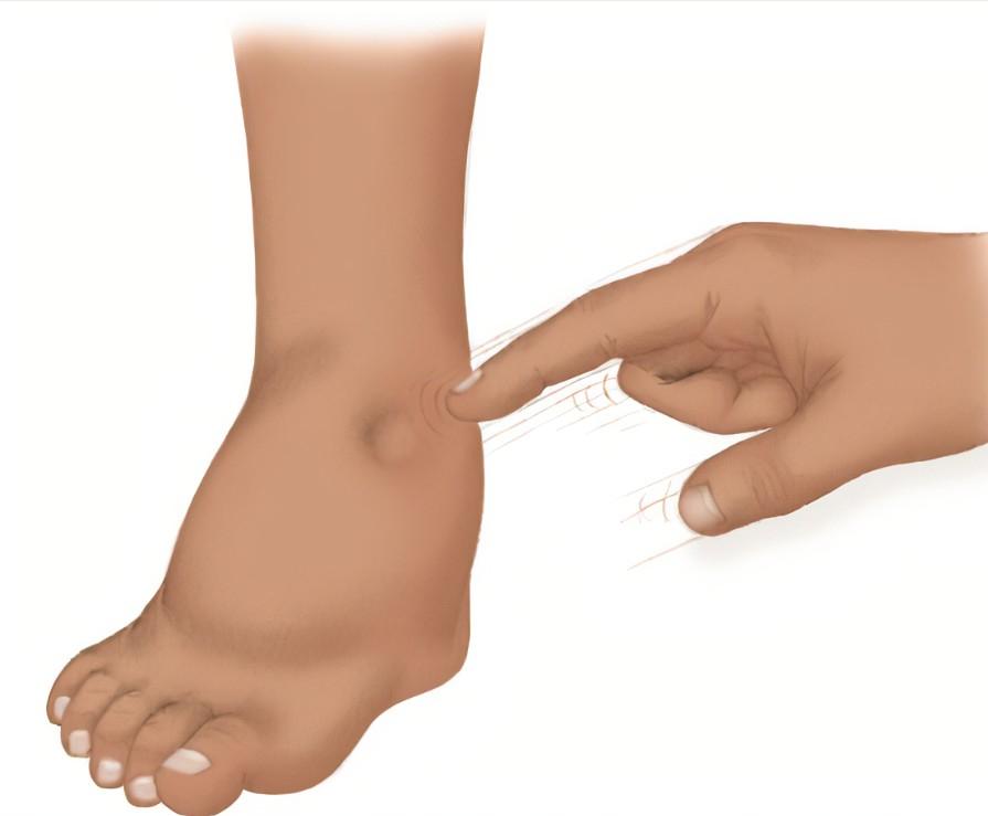 各种类型水肿的典型表现汇总,水肿的评估方法和分级