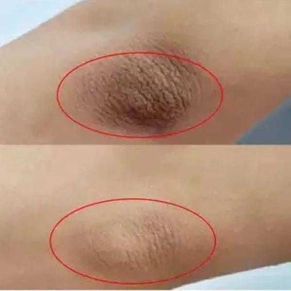 黑胳膊肘黑膝盖怎么变白,手肘黑关节黑膝盖黑怎么办