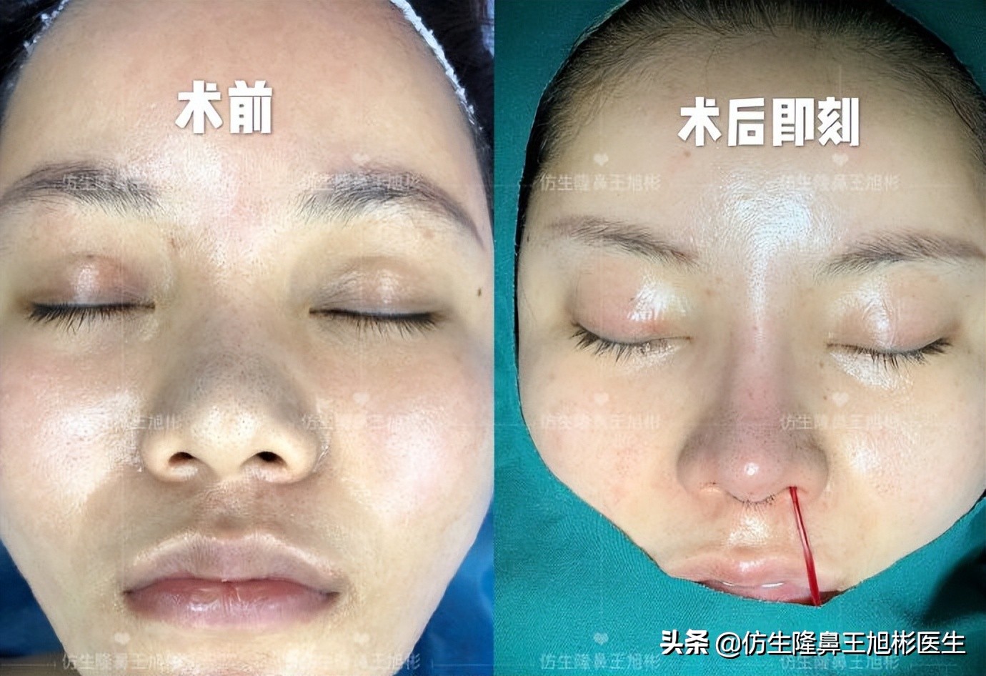 鼻头部位整形,鼻头圆钝高鼻梁整形案例