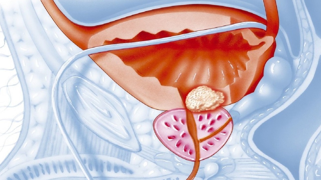 60岁还想有夫妻生活，可以吃他达拉非吗？怎样能保证效果和安全？