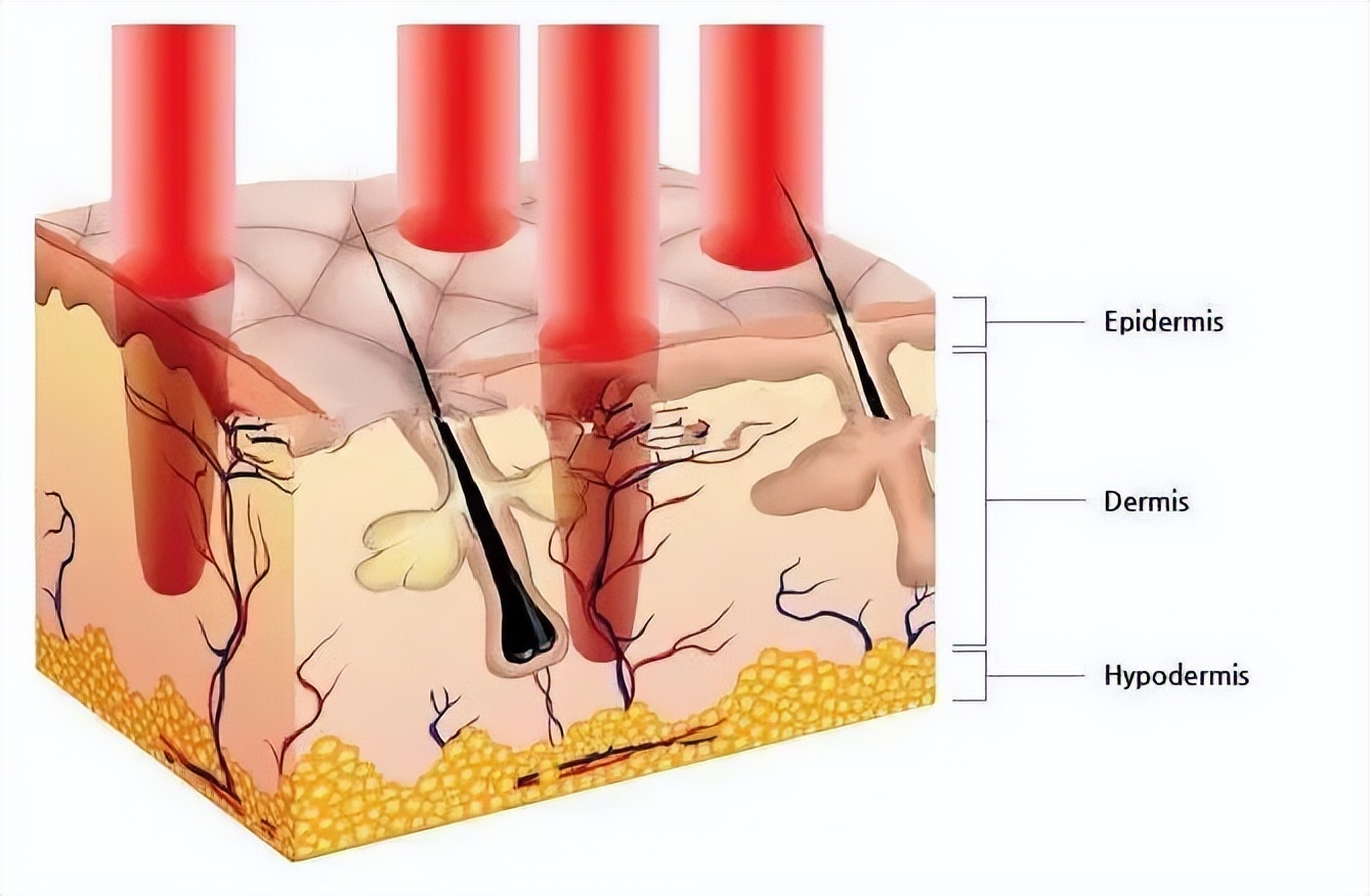 点阵激光是用来干嘛的,点阵激光收缩毛孔管用吗