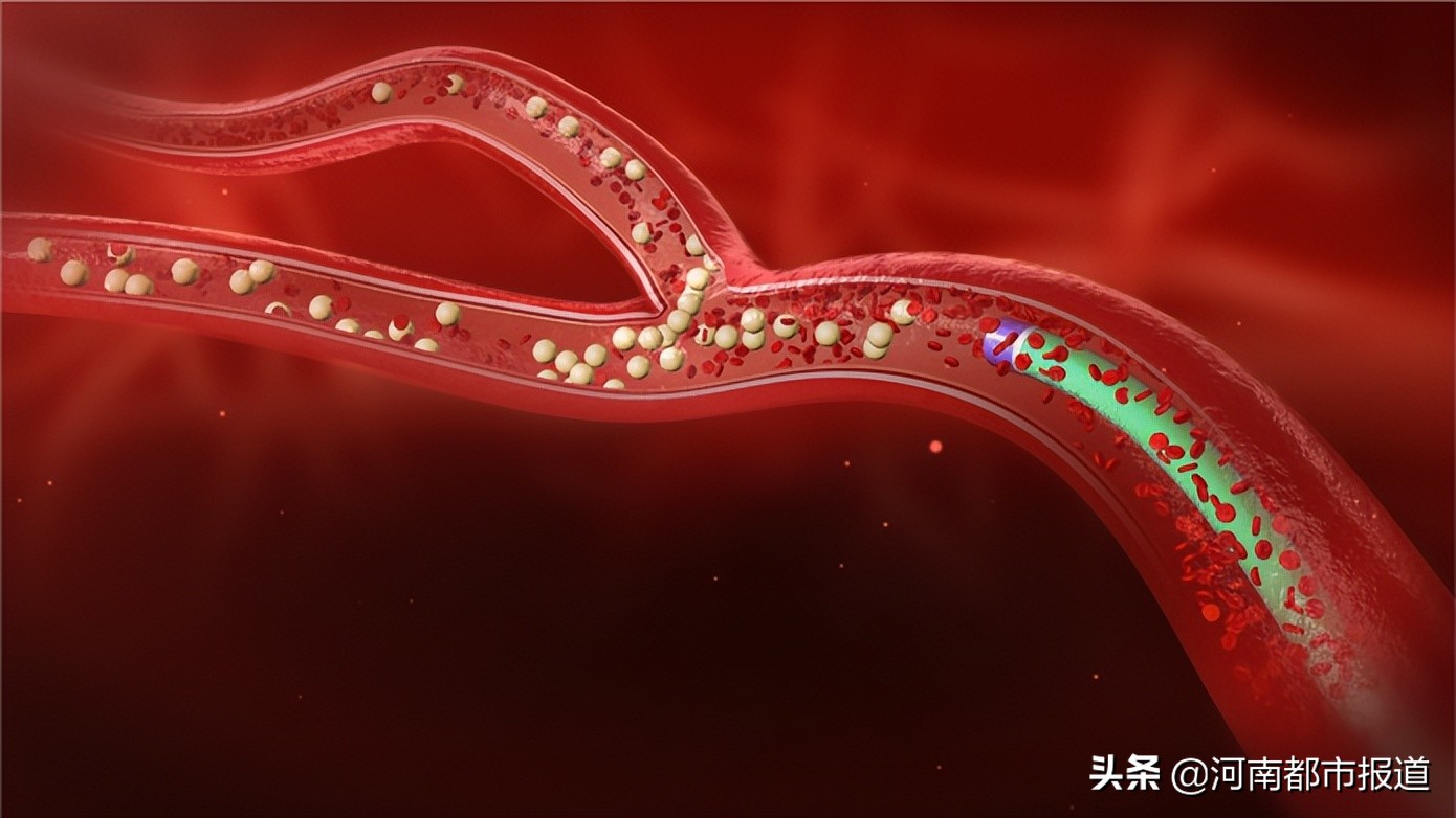 国内首例钇90微球治疗成功,肝癌系统治疗新进展