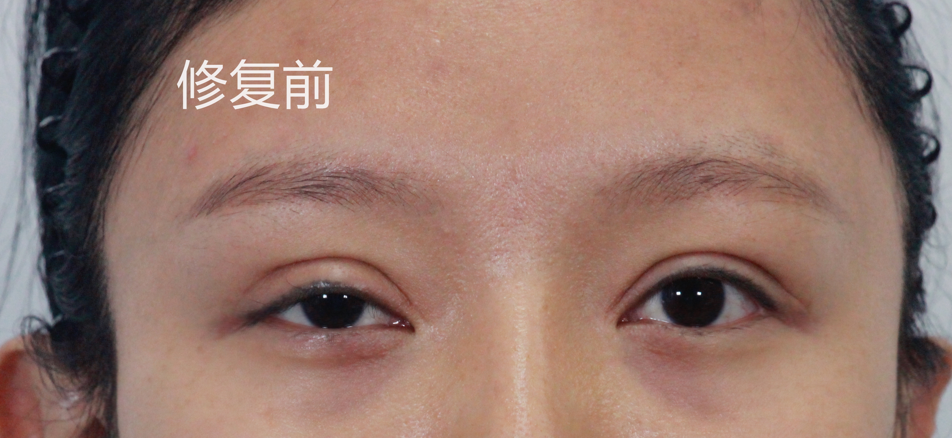 我做了双眼皮下眼睑会肿怎么回事,做了双眼皮十天肉条感严重怎么办