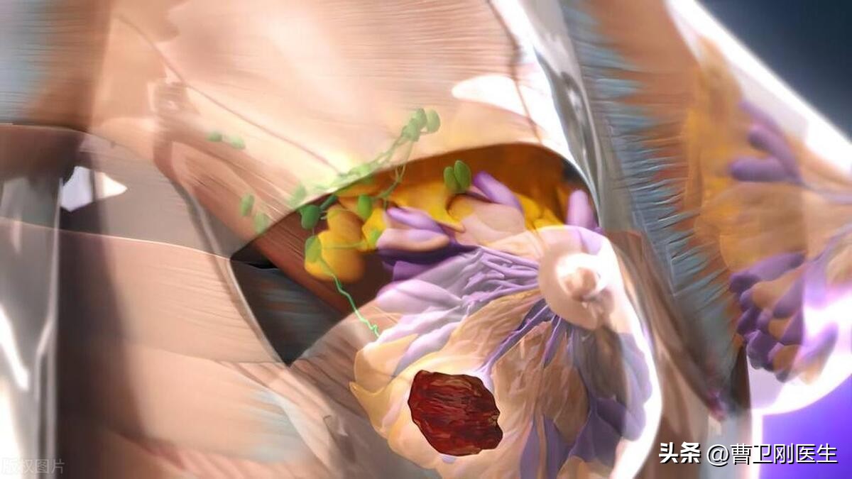 副乳腺病是什么,副乳腺是什么意思