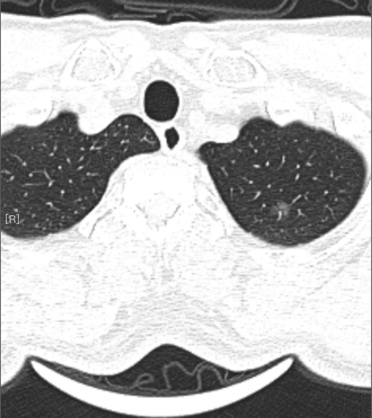 【患者分享】一位多发肺磨玻璃结节患者微波消融除磨后的心路历程