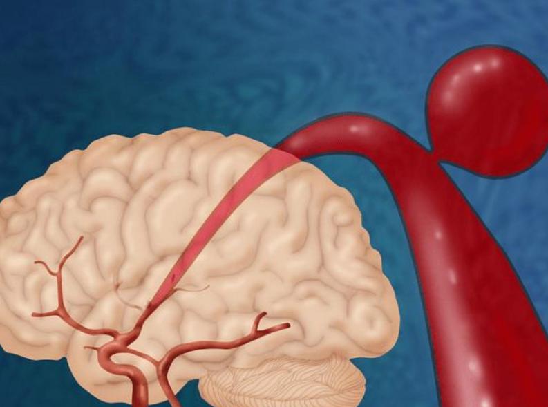 通过“脑之玄府”理论，来谈谈脑梗死的中医辨治思路