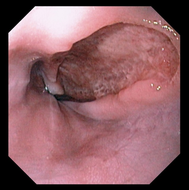 治疗胃溃疡的奥美拉唑、泮托拉唑、雷贝拉唑、艾司奥美拉唑如何选