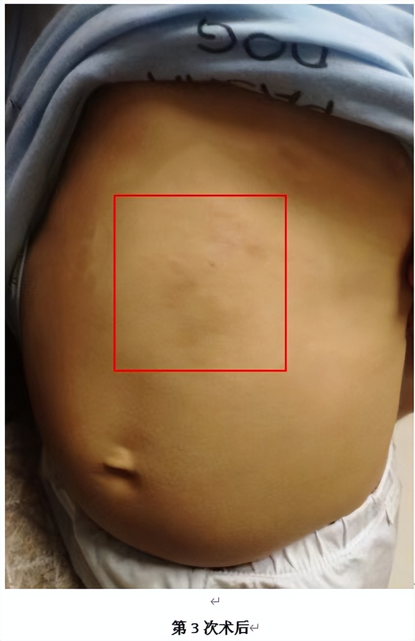 淋巴管瘤的微创治疗,淋巴管瘤微创介入手术第二天