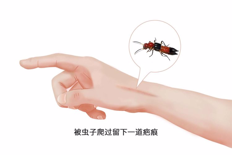 男子皮肤瘙痒还冒出白色虫子,医生检查阴虱的镊子和刀片