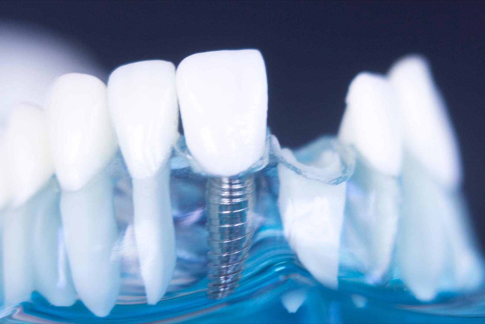 牙齿贴面的材料和品牌区别,牙贴面品牌十大排名最新