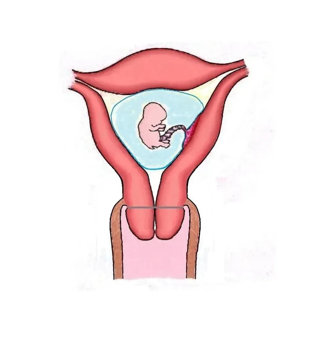 双胞胎怀孕20周，医生竟然要缝合我的宫颈