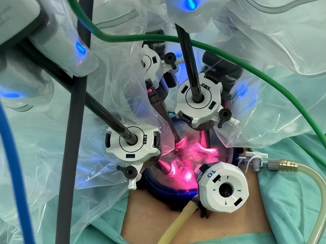 哈医大一院泌尿外科“新辅助”神奇疗法可缩小前列腺肿瘤为晚期前列腺癌治疗带来新方案