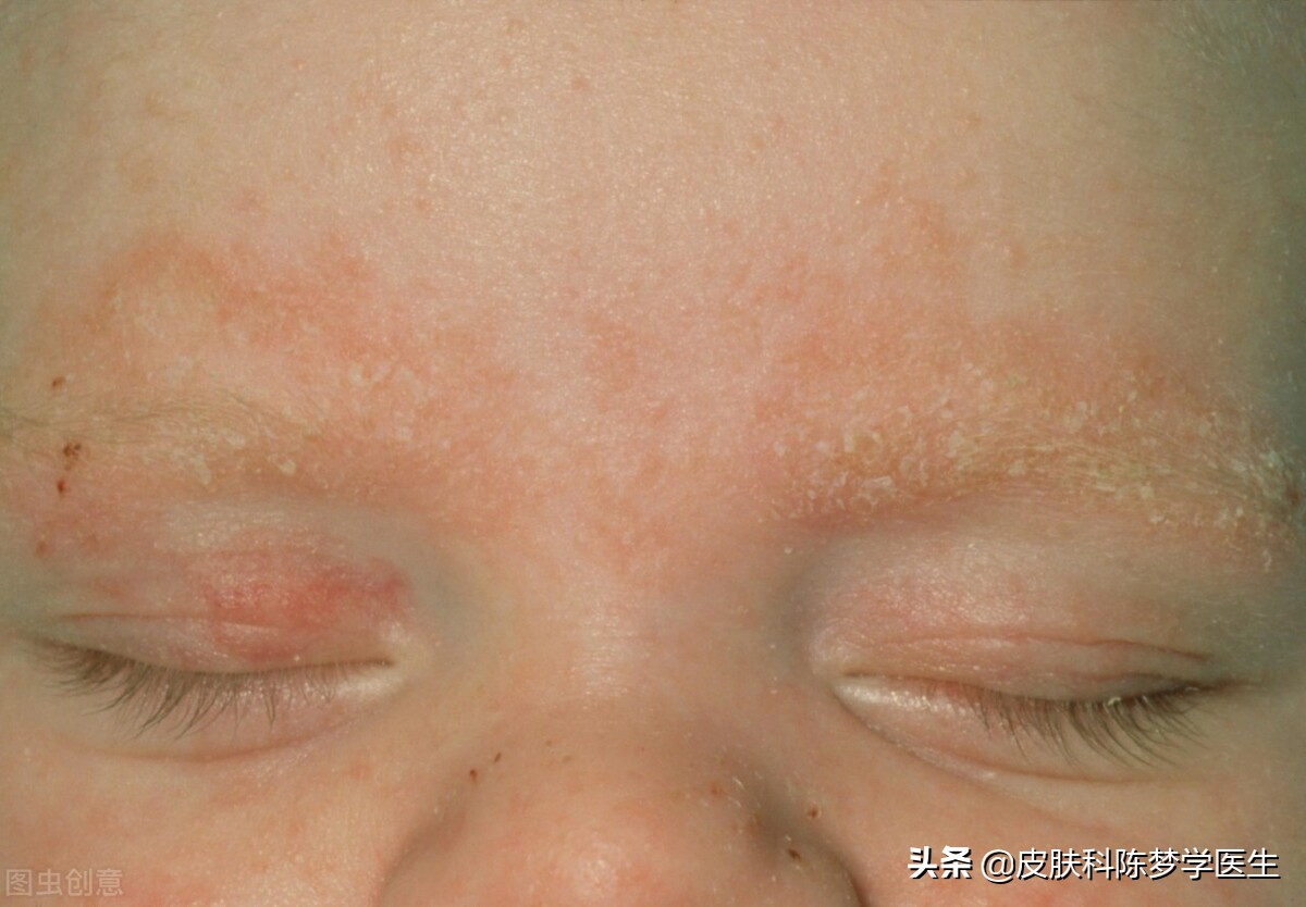 脸上银屑病引起的红斑突然严重,脂溢性皮炎脸上有一块块红斑