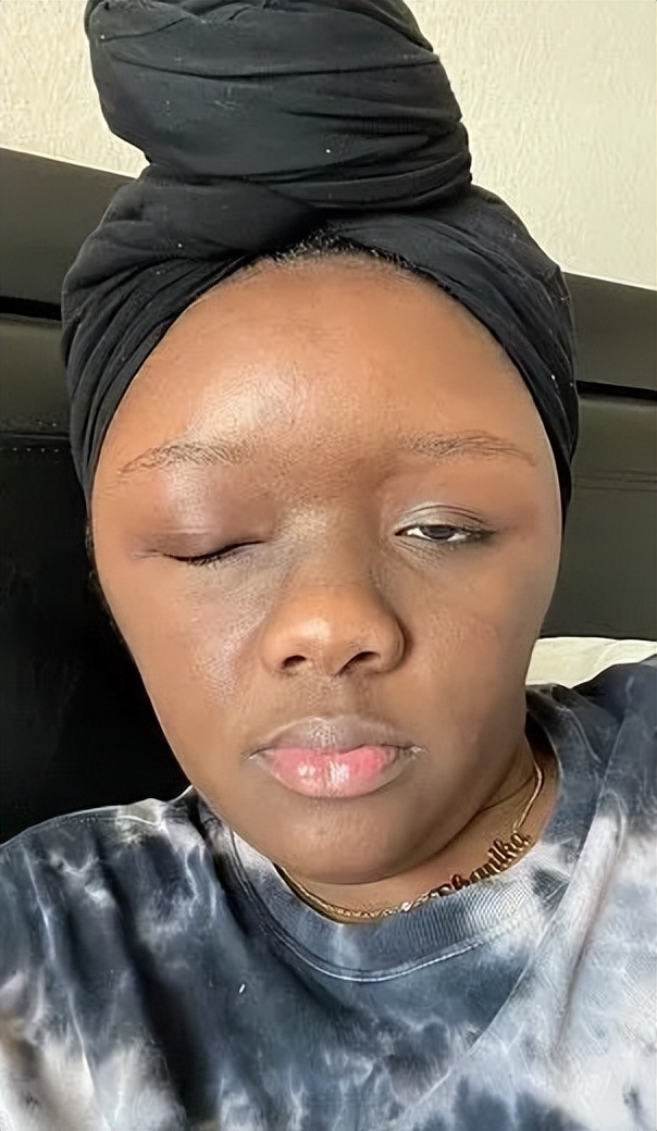 美国妹子染头发过敏全脸肿成emoji，不光失明还险些窒息