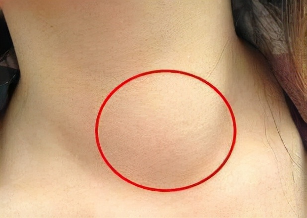 薛永东治甲状腺结节的方子,治疗甲状腺结节的中药方子