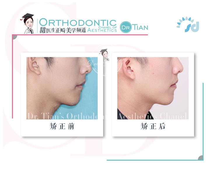 上下牙无法咬合是怎么回事,30岁牙齿咬合开颌还有必要矫正吗