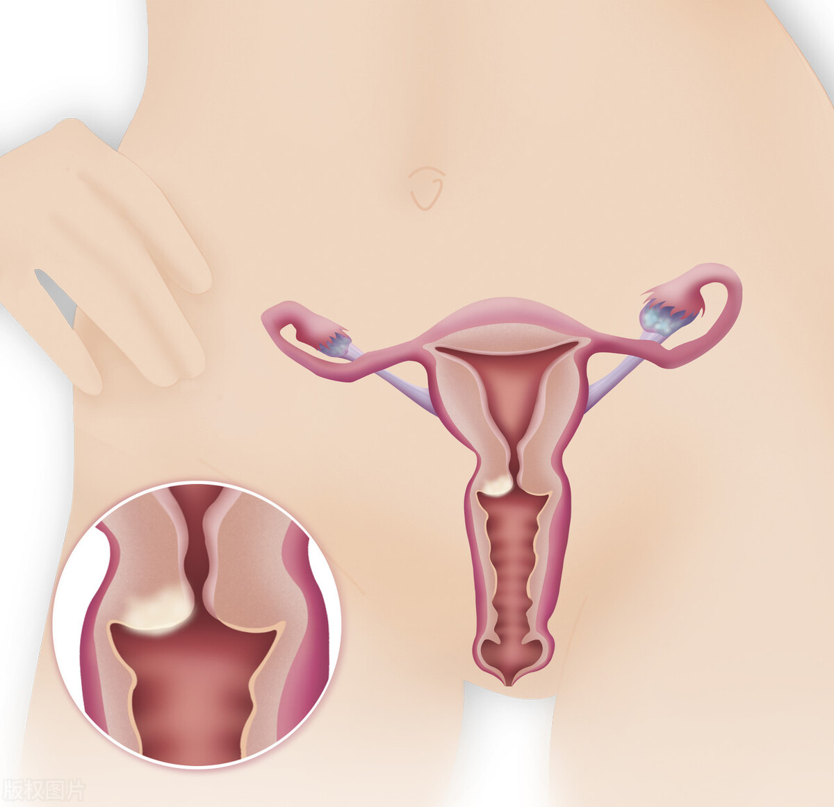 hpv12阳性是宫颈癌吗,宫颈癌跟hpv有什么关系