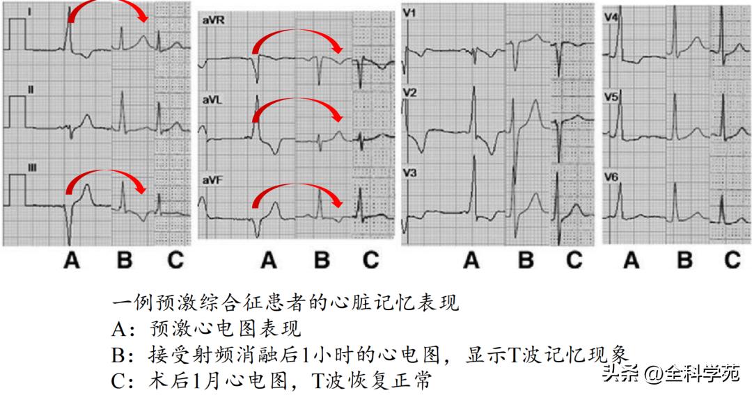 t波倒置三种常见原因,t波低平倒置有事吗