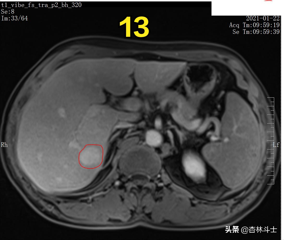 肝癌8公分肿瘤能活多久,肝癌细胞最大长多大