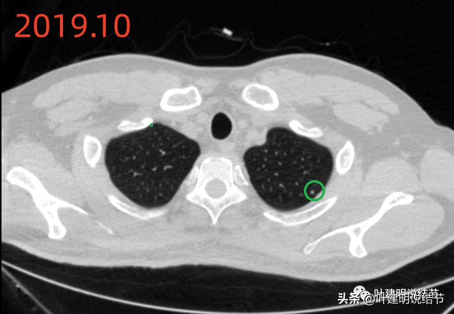 肺炎好了磨玻璃结节还存在,球形肺炎治愈后肺部留有结节