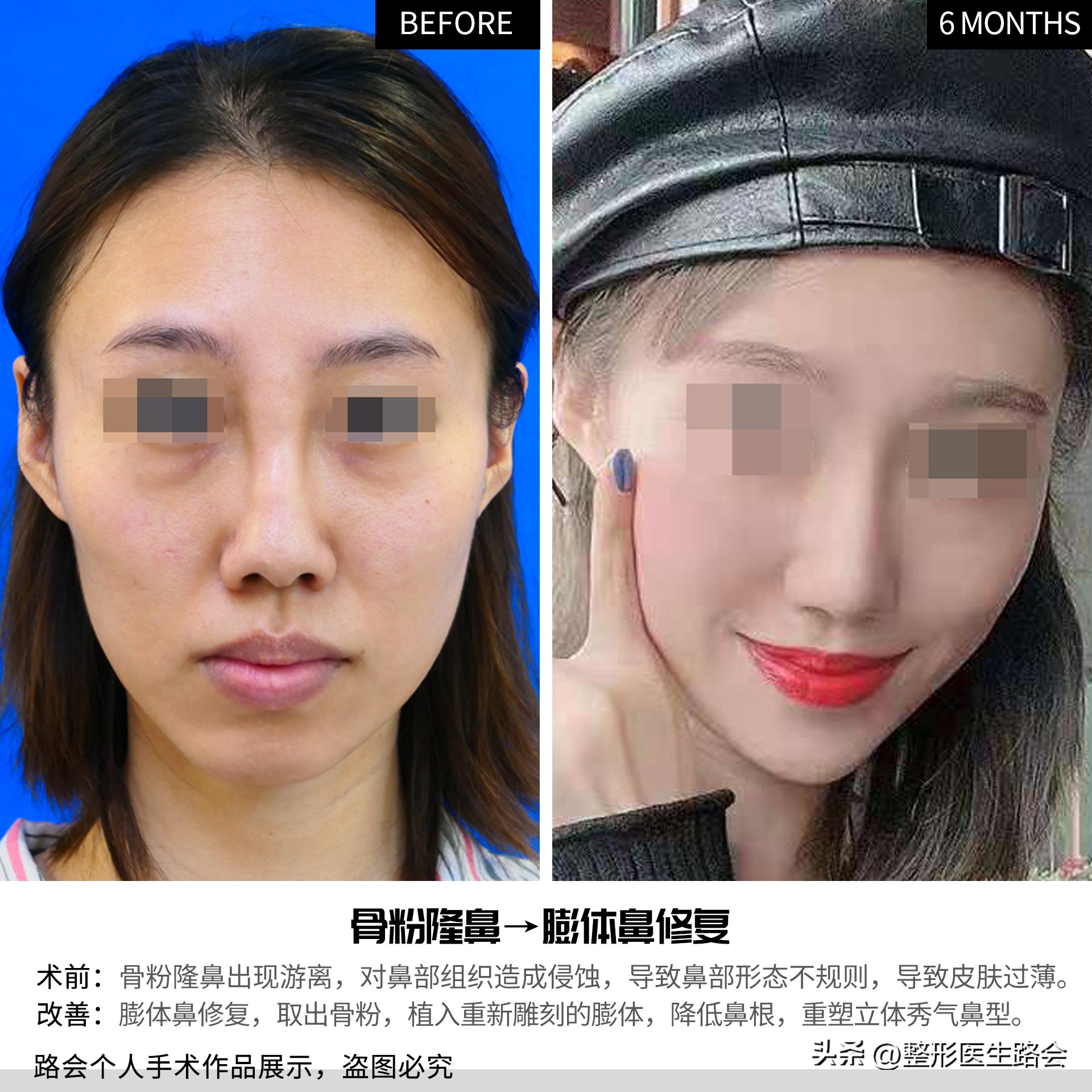 千万别做硅胶隆鼻,千万不要做玻尿酸隆鼻