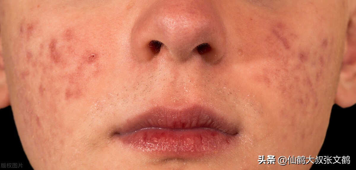 鹤叔十滴水治痘印,鹤叔淡化痘印小妙招
