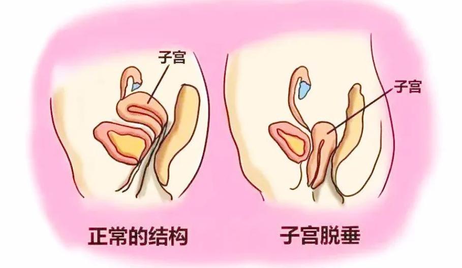 濂冲瓙渚跨瀵艰嚧瀛愬鑴卞瀭,鏀惧眮瀵艰嚧瀛愬鑴卞瀭
