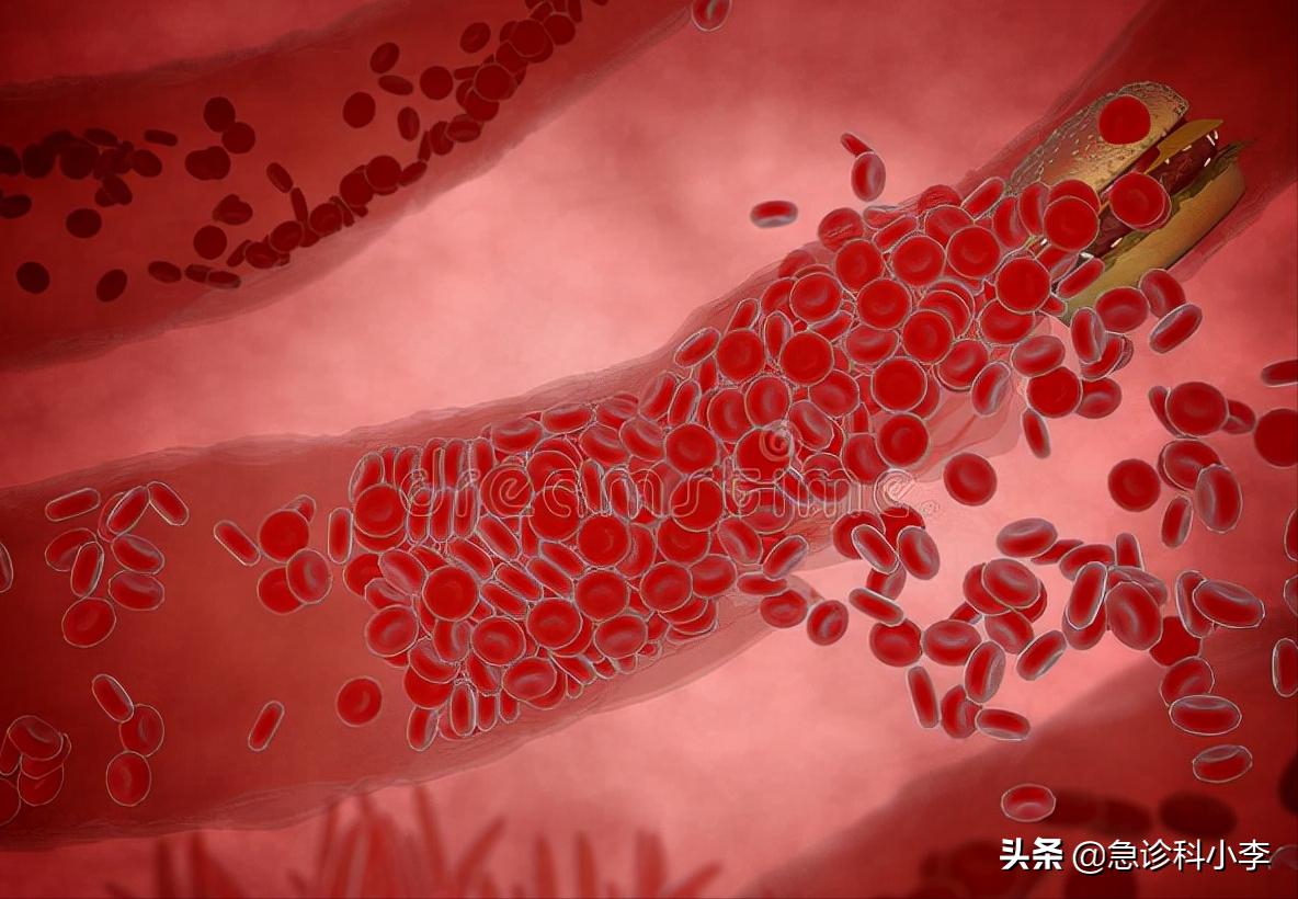 睡觉时突然腿抽筋是缺钙引起的吗,睡觉腿抽筋除了缺钙还有3个原因