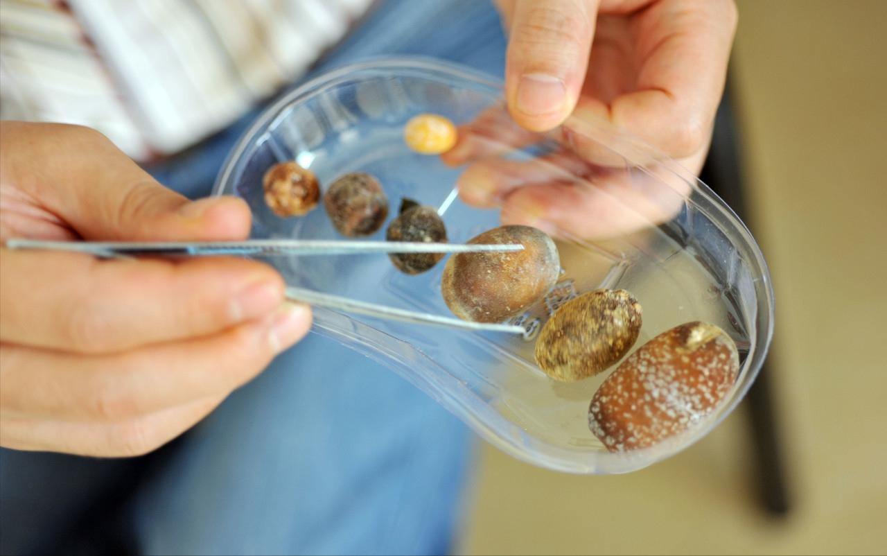 腹腔镜下胆总管切开取石治疗,充填型胆囊结石用腹腔镜怎样切除