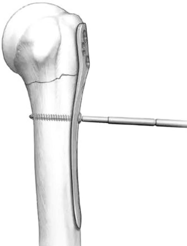 肱骨近端骨折属于几级伤残,肱骨近端骨折康复训练技巧