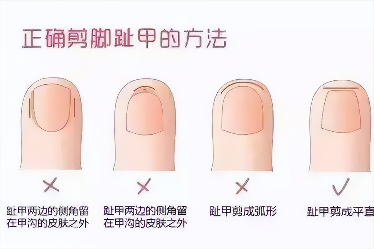 怎么治疗甲沟炎最快最好的方法,如何治疗甲沟炎效果最佳