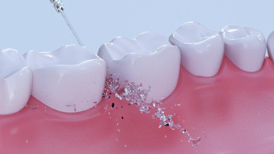 牙缝有牙结石怎么去除,牙缝间的牙结石怎么清除