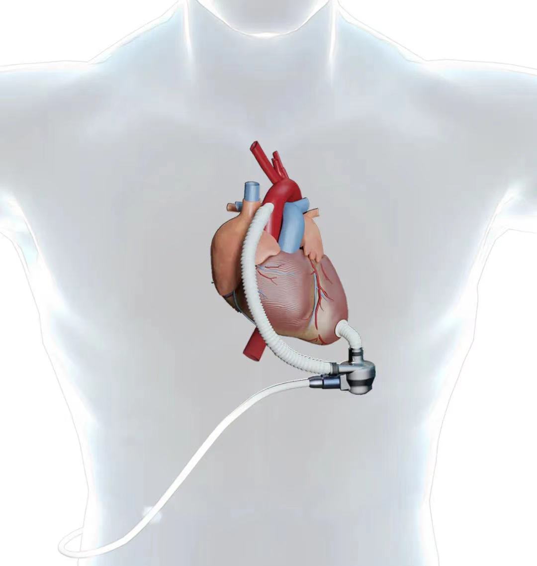 中国首例人工心脏植入手术,甘肃成功首例人工心脏植入手术