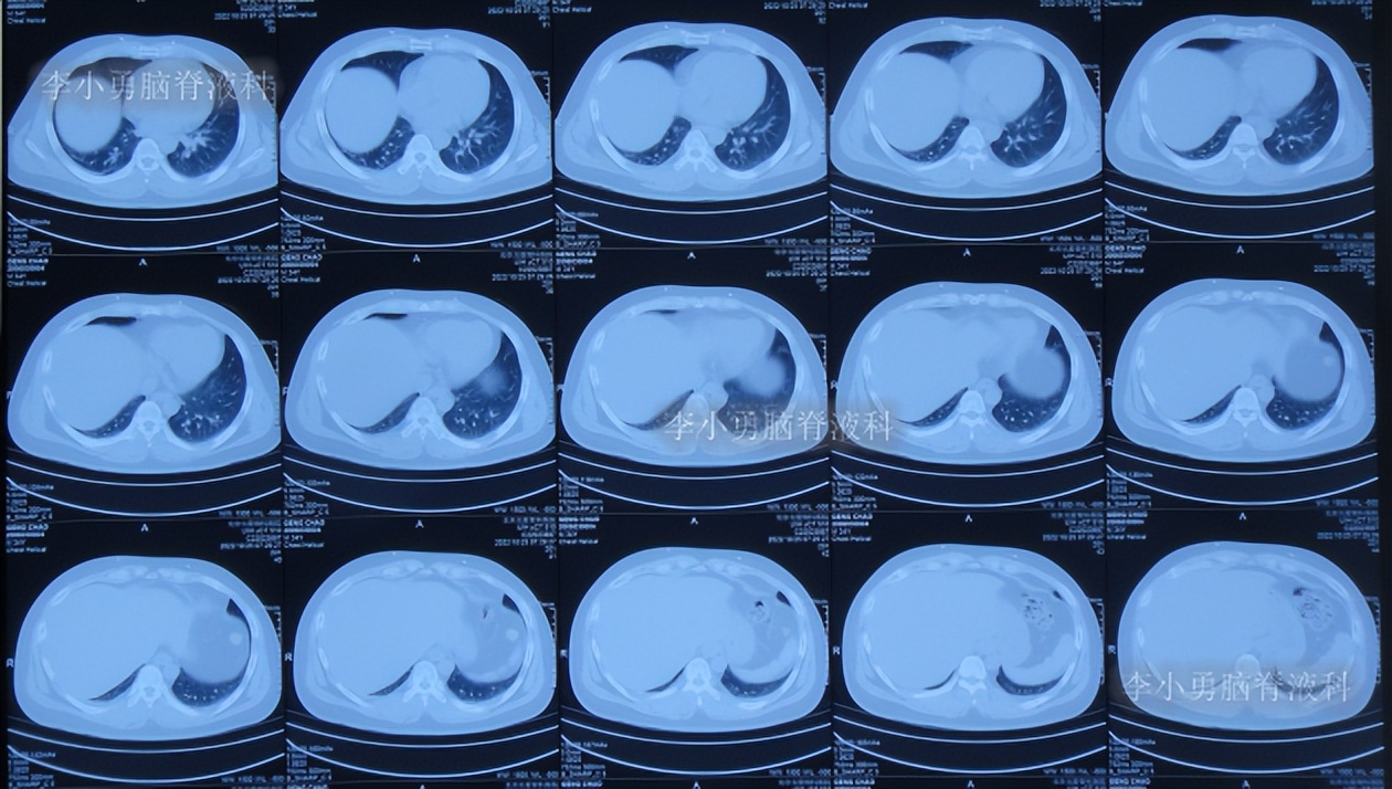 脑积水三脑室造瘘多久能恢复,脑囊虫手术后脑积水