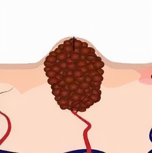 如何区别黑痣和黑色素瘤,怎样区别黑痣和黑色素瘤