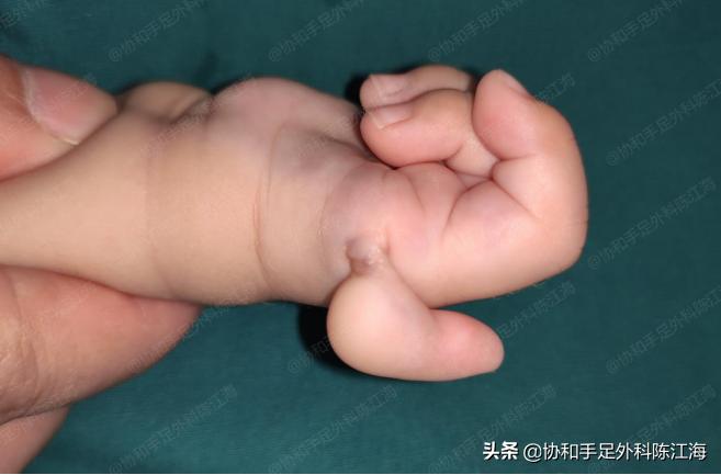 两个月宝宝大拇指连着手掌,三个月婴儿拇指并指可以手术吗