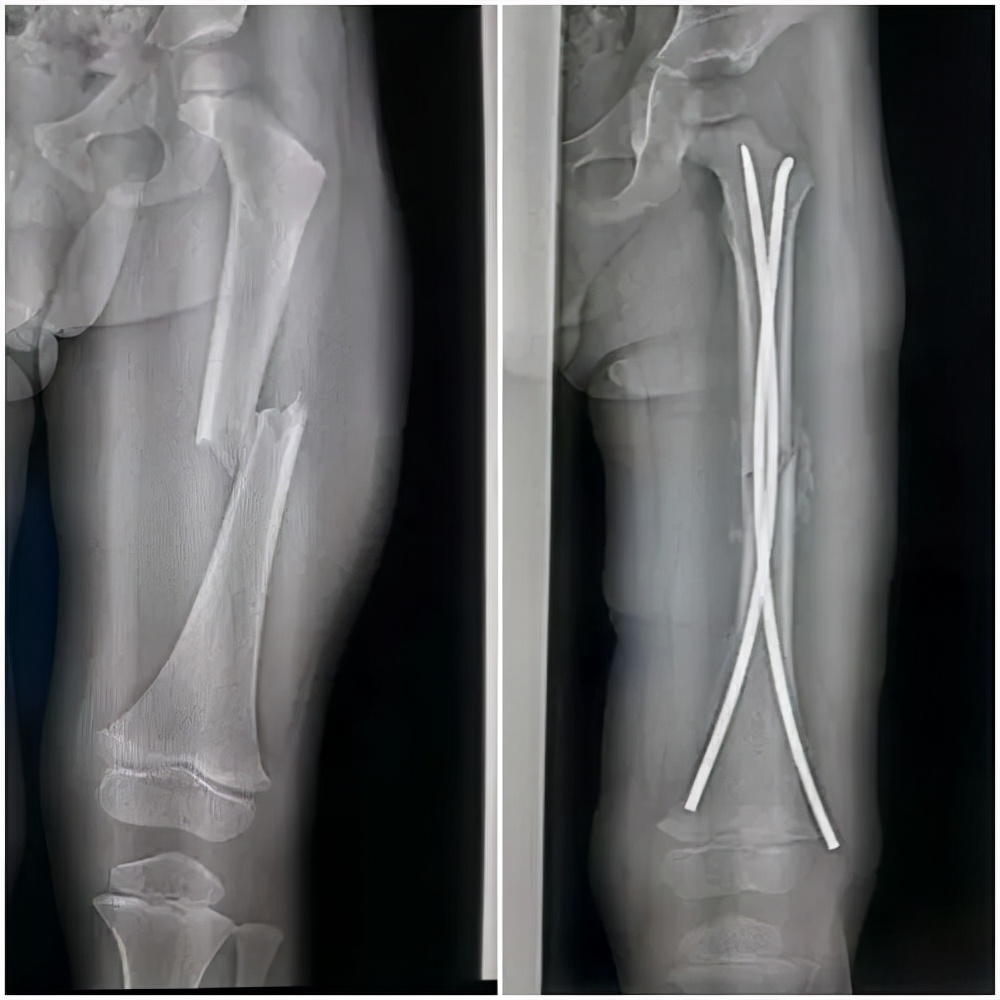 儿童股骨骨折手术全过程,小孩股骨骨折保守治疗还是手术