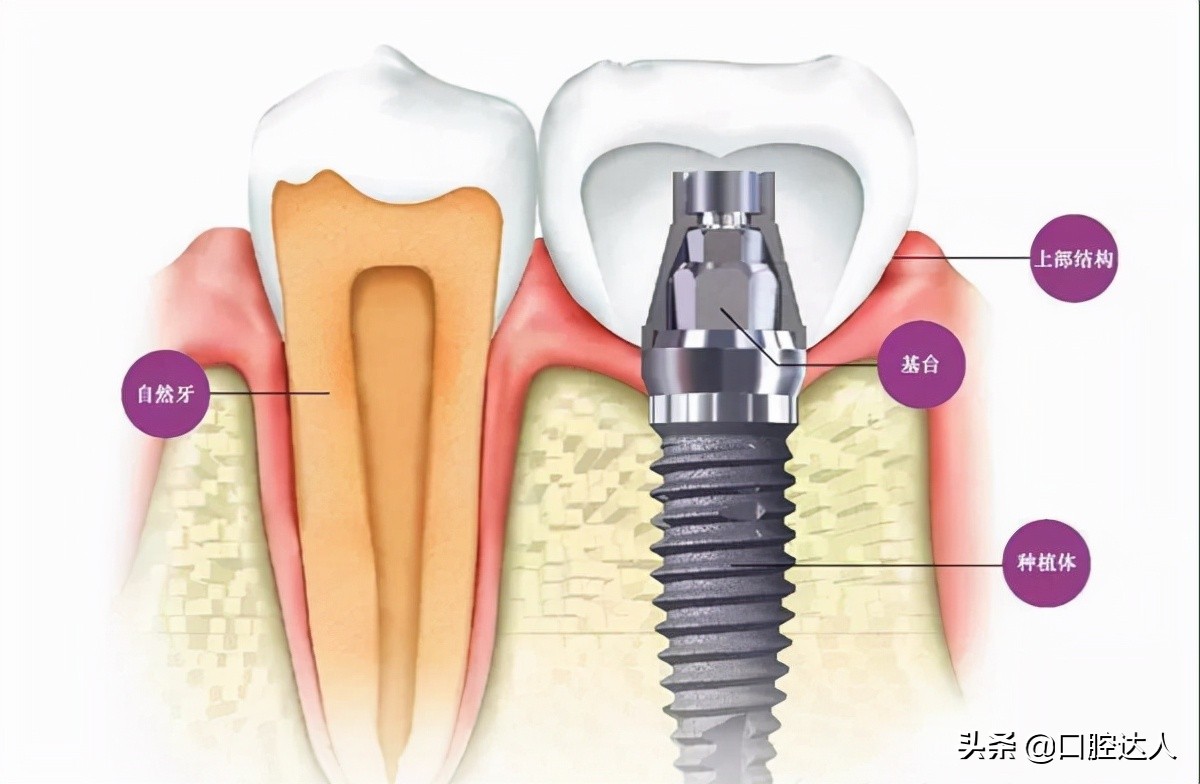 种植牙的流程分多少期,种植牙的过程包含哪些流程
