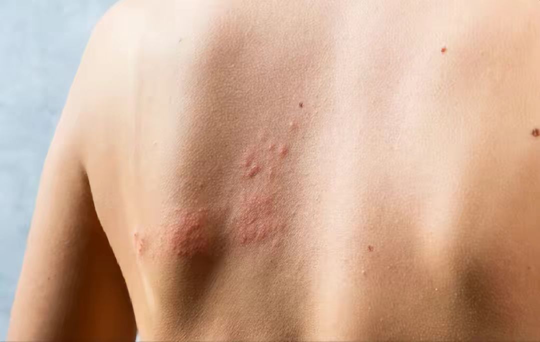 蛇缠腰带状疱疹怎么治最好,蛇缠腰带状疱疹怎么才算治好