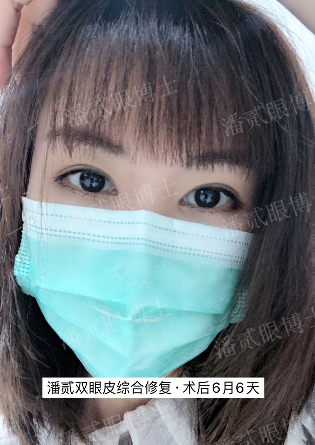 割双眼皮就割一只眼,割双眼皮提肌有风险吗