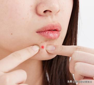 蕾特恩痘印,蕾特恩祛痘留下痘印