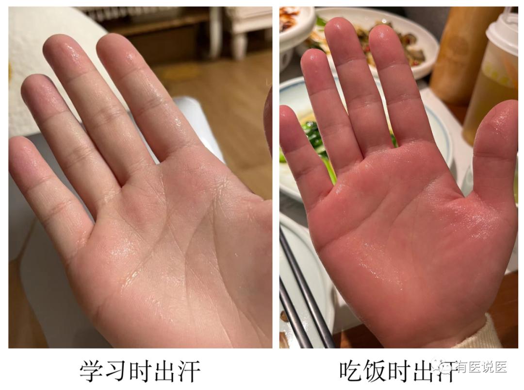 手汗症从什么年龄开始知道,健康科普手汗症你了解多少