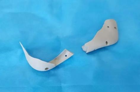 半侧颜面短小症是什么原因导致的,半侧颜面畸形如何改善